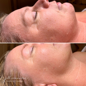 fruitzuurpeeling Resultaat anti-rimpel Gelaatsverzorging Zutendaal Limburg Jill Vannueten | Skincare, Beauty & Make-up
