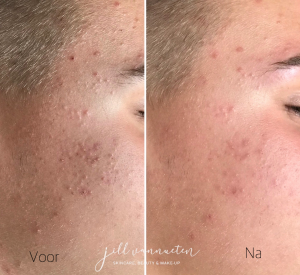 acné behandeling resultaat Gelaatsverzorging Zutendaal Limburg Jill Vannueten | Skincare, Beauty & Make-up