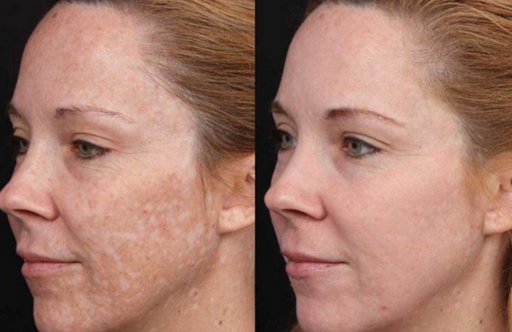 JVN Aesthetic Clinic Cosmelan (pigmentatie) Cosmelan pigmentbehandeling JVN aesthetic Clinic, Schoonheidssalon in Zutendaal 5