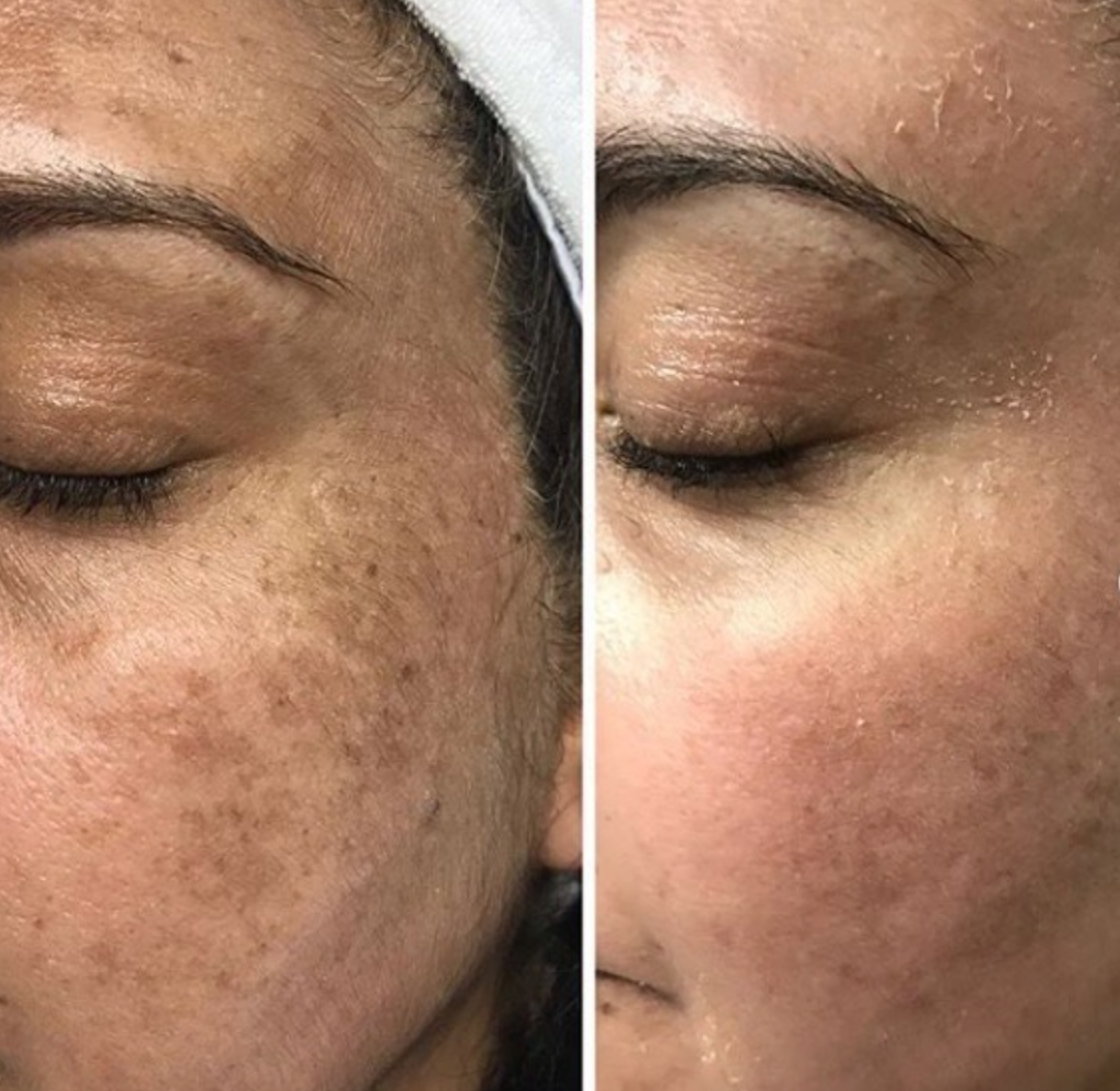 JVN Aesthetic Clinic Cosmelan (pigmentatie) Cosmelan pigmentbehandeling JVN aesthetic Clinic, Schoonheidssalon in Zutendaal 8