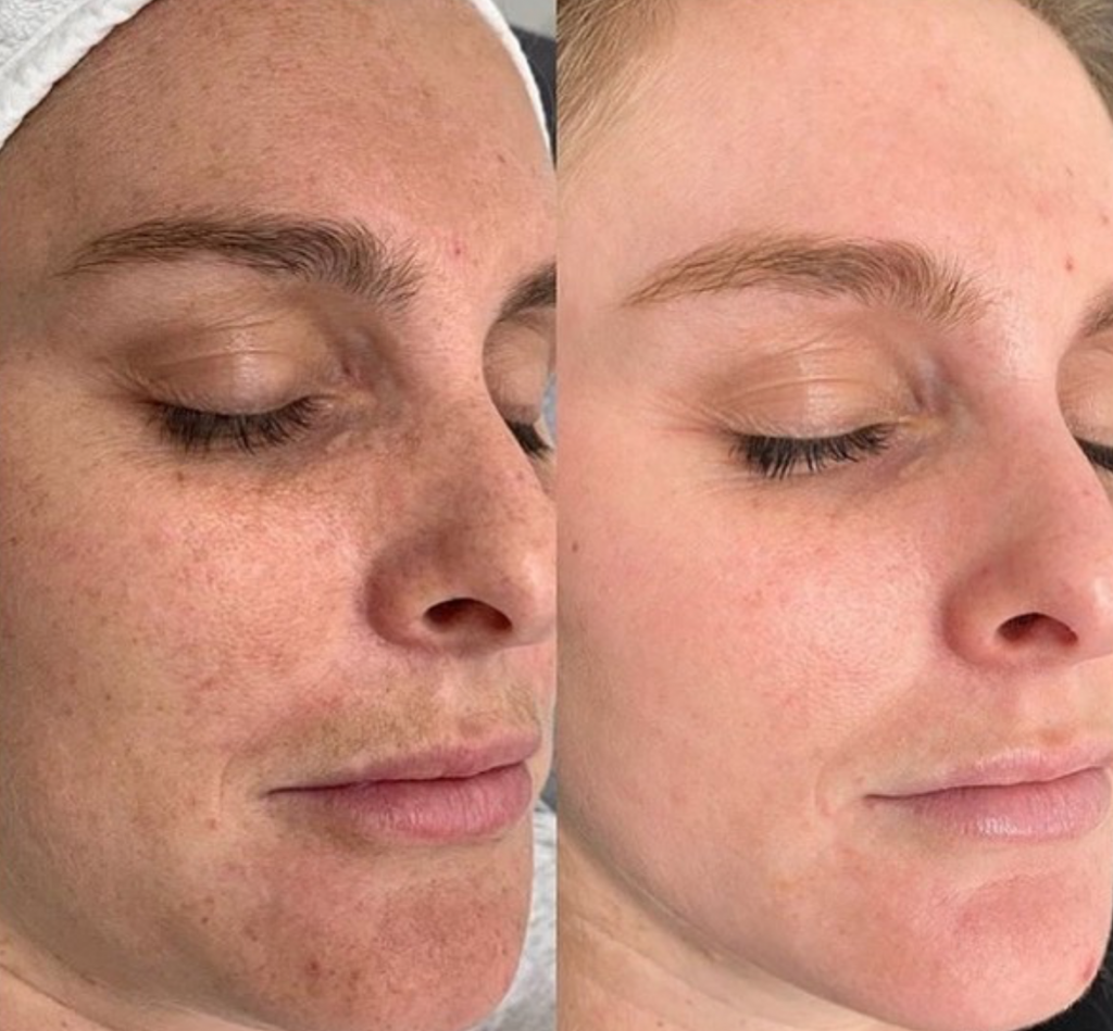 JVN Aesthetic Clinic Cosmelan (pigmentatie) Cosmelan pigmentbehandeling JVN aesthetic Clinic, Schoonheidssalon in Zutendaal 9