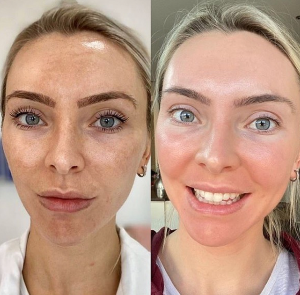 JVN Aesthetic Clinic Cosmelan (pigmentatie) Cosmelan pigmentbehandeling JVN aesthetic Clinic, Schoonheidssalon in Zutendaal 10
