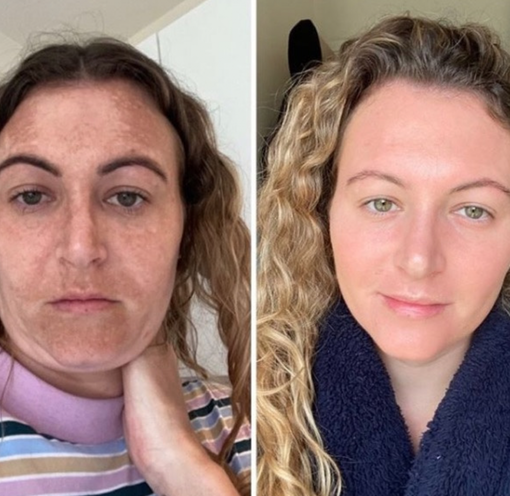 JVN Aesthetic Clinic Cosmelan (pigmentatie) Cosmelan pigmentbehandeling JVN aesthetic Clinic, Schoonheidssalon in Zutendaal 11