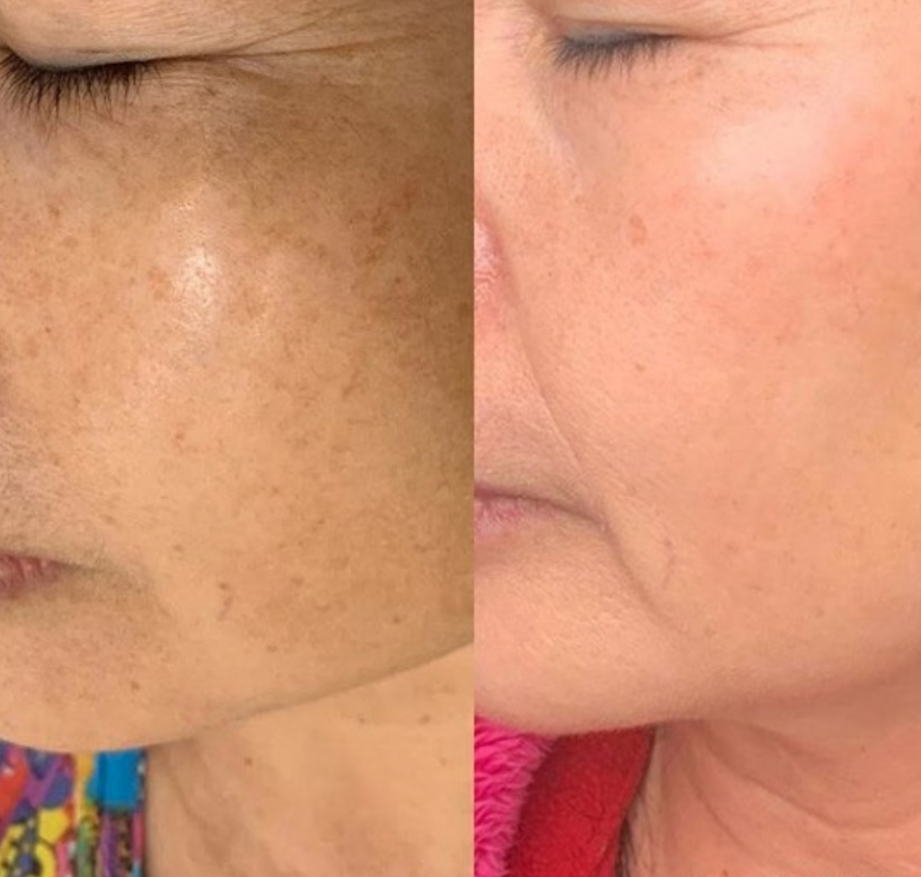 JVN Aesthetic Clinic Cosmelan (pigmentatie) Cosmelan pigmentbehandeling JVN aesthetic Clinic, Schoonheidssalon in Zutendaal 12
