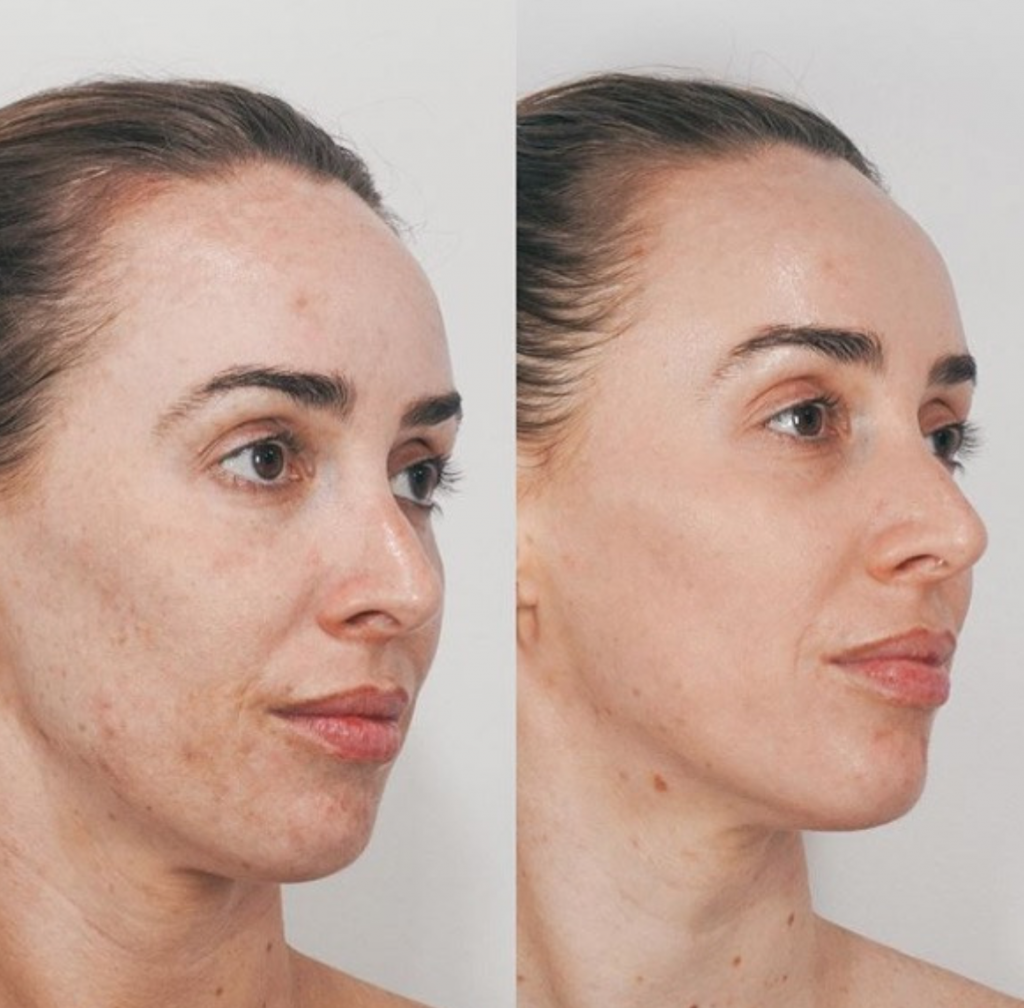 JVN Aesthetic Clinic Cosmelan (pigmentatie) Cosmelan pigmentbehandeling JVN aesthetic Clinic, Schoonheidssalon in Zutendaal 13