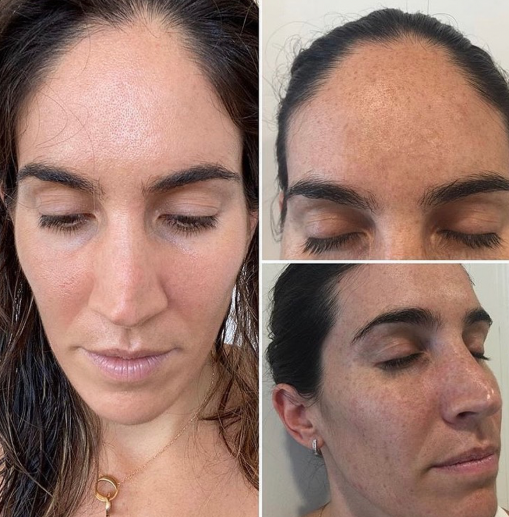 JVN Aesthetic Clinic Cosmelan (pigmentatie) Cosmelan pigmentbehandeling JVN aesthetic Clinic, Schoonheidssalon in Zutendaal 14