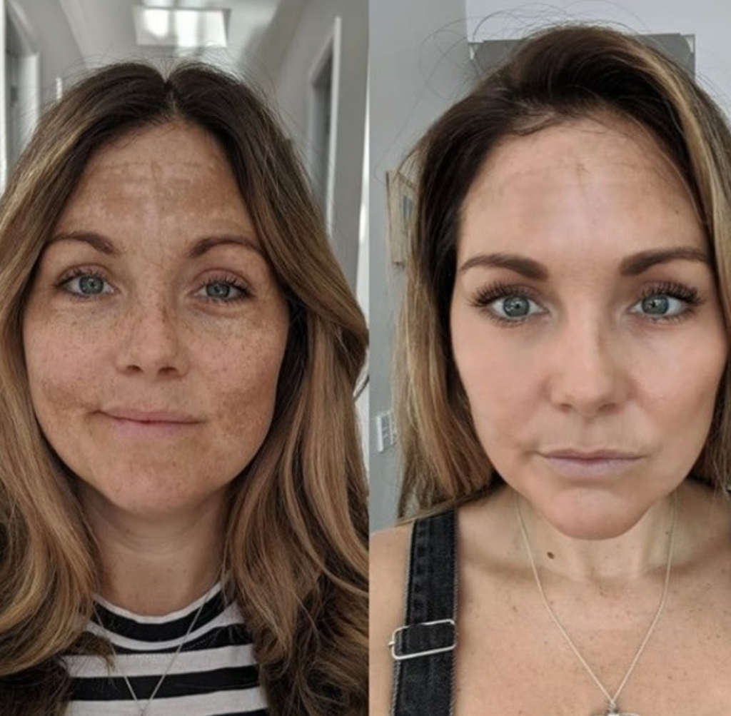 JVN Aesthetic Clinic Cosmelan (pigmentatie) Cosmelan pigmentbehandeling JVN aesthetic Clinic, Schoonheidssalon in Zutendaal 17