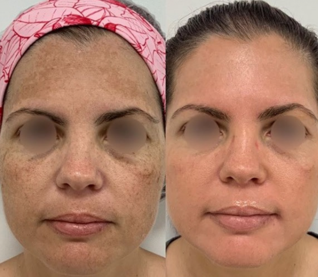 JVN Aesthetic Clinic Cosmelan (pigmentatie) Cosmelan pigmentbehandeling JVN aesthetic Clinic, Schoonheidssalon in Zutendaal 18