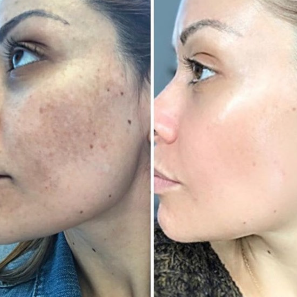 JVN Aesthetic Clinic Cosmelan (pigmentatie) Cosmelan pigmentbehandeling JVN aesthetic Clinic, Schoonheidssalon in Zutendaal 19