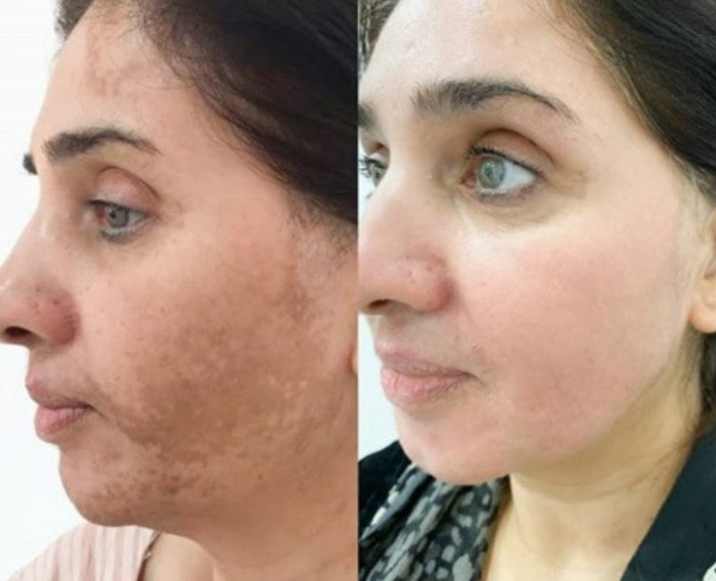 JVN Aesthetic Clinic Cosmelan (pigmentatie) Cosmelan pigmentbehandeling JVN aesthetic Clinic, Schoonheidssalon in Zutendaal 20