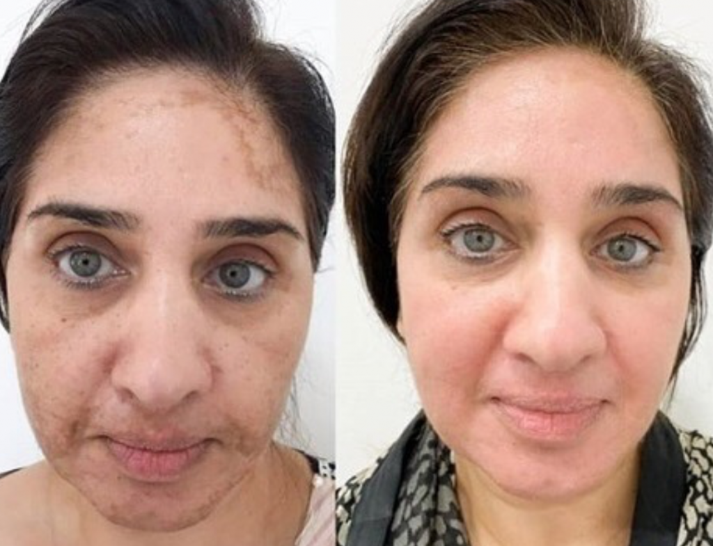 JVN Aesthetic Clinic Cosmelan (pigmentatie) Cosmelan pigmentbehandeling JVN aesthetic Clinic, Schoonheidssalon in Zutendaal 21